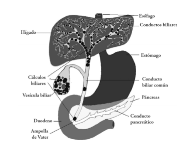 Cálculos biliares en el higado y la vesícula