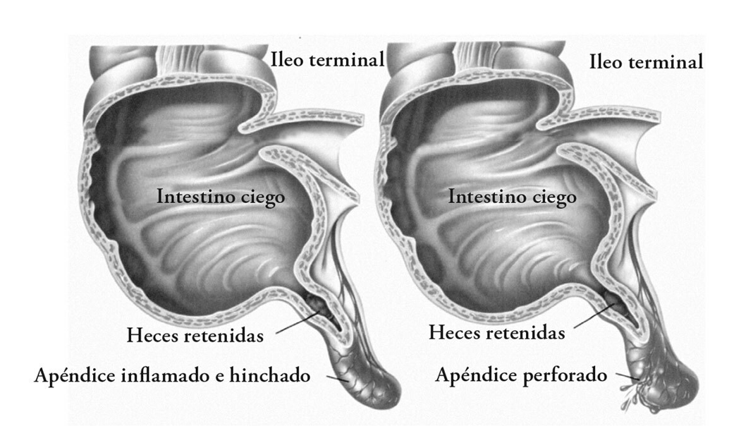 Ilustración de inflamación y perforación del apéndice